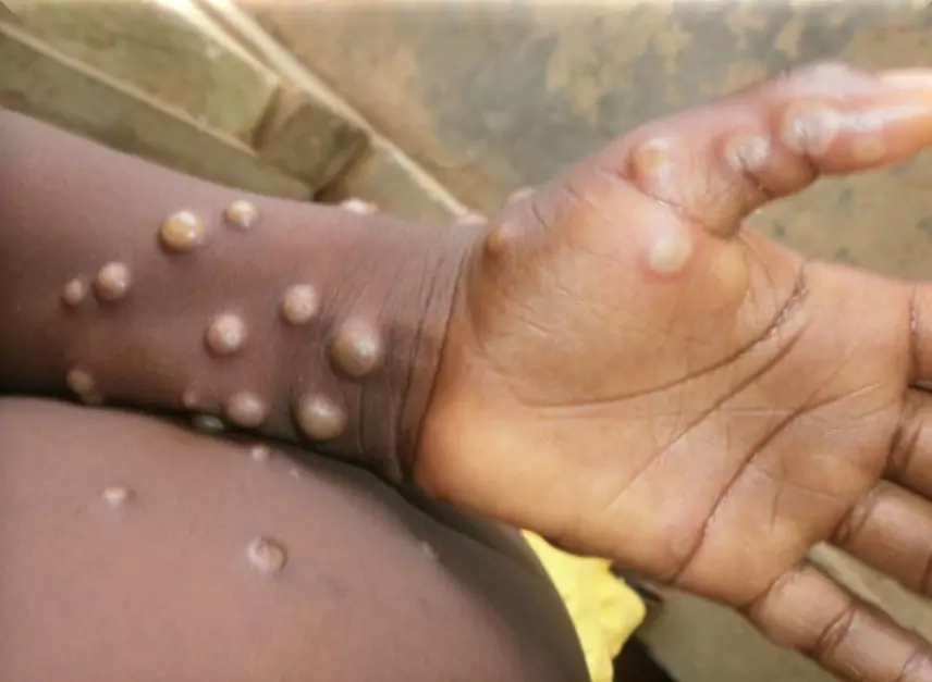 Mpox Virus Symptoms and How It Attacks the Human Body